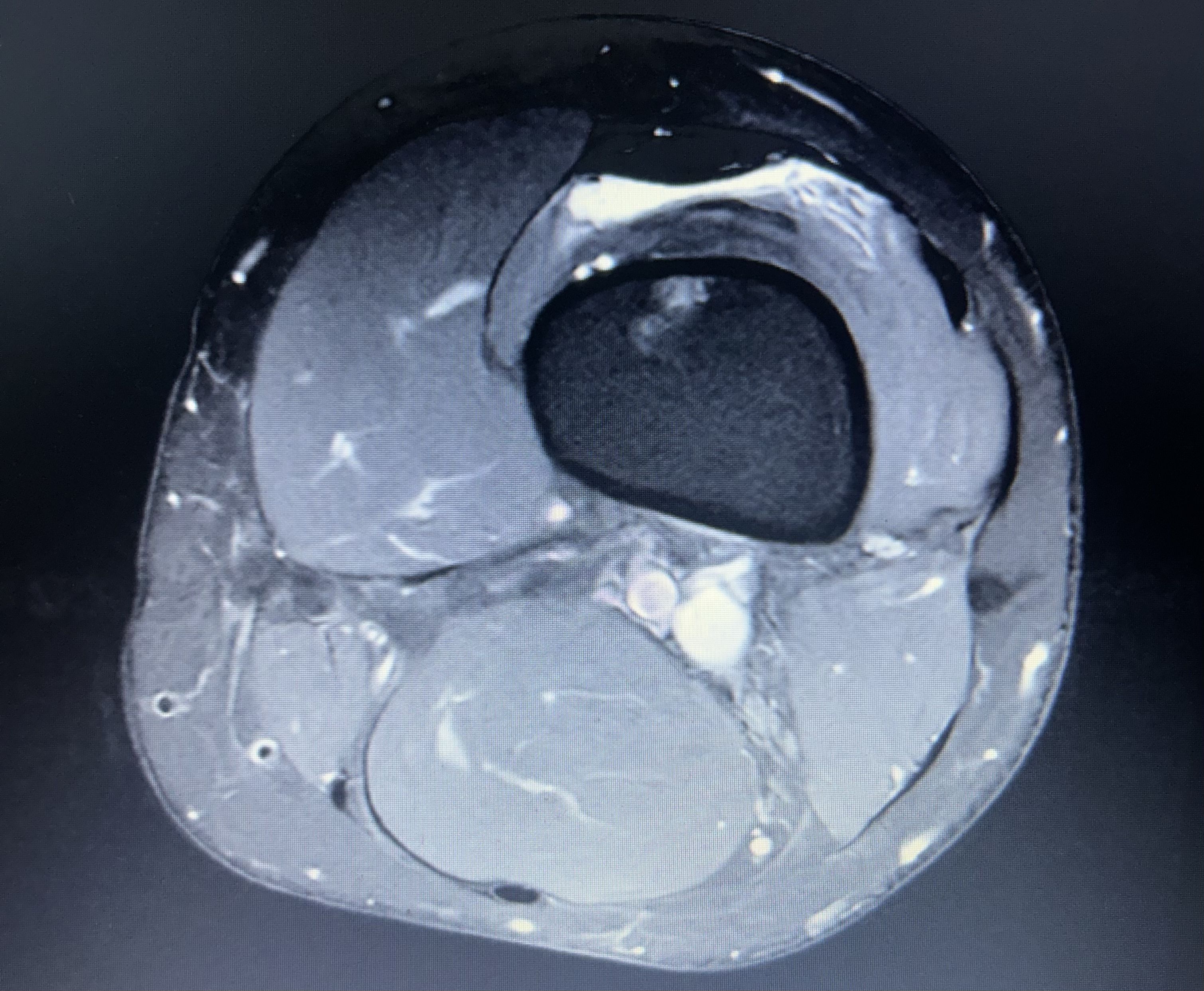 Knee MRI